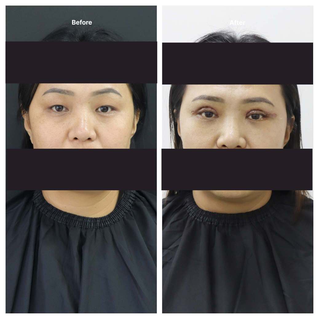 Eyelid Surgery KOQ10